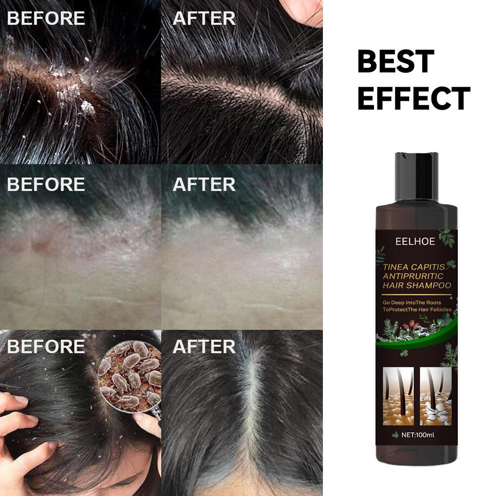 EELHOE Anti-Dandruff Shampoo - Itch Relief, Hair Loss Prevention, Oil Control & Refreshing Care by DC-THE CEO